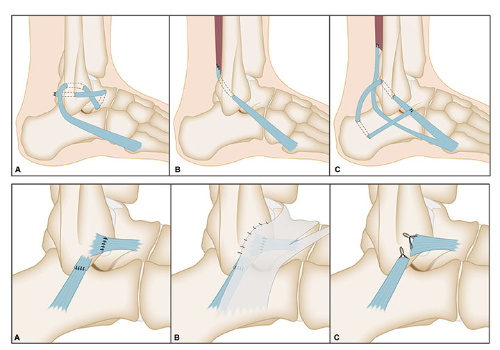 Ankle Tendon Repair